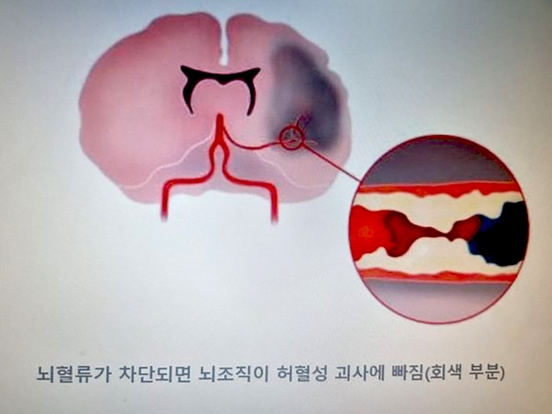 뇌절증1.jpg