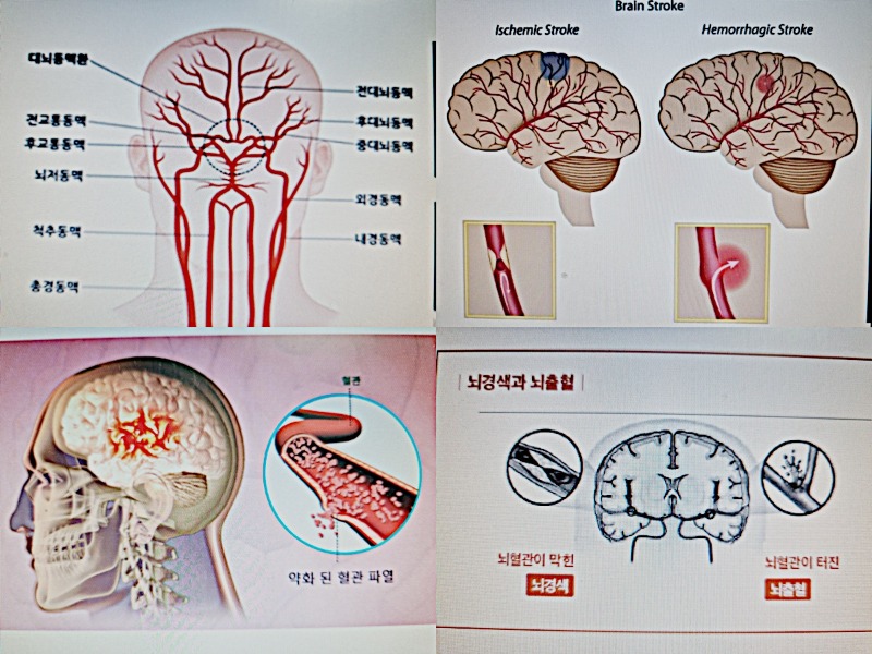 뇌졸증.jpg